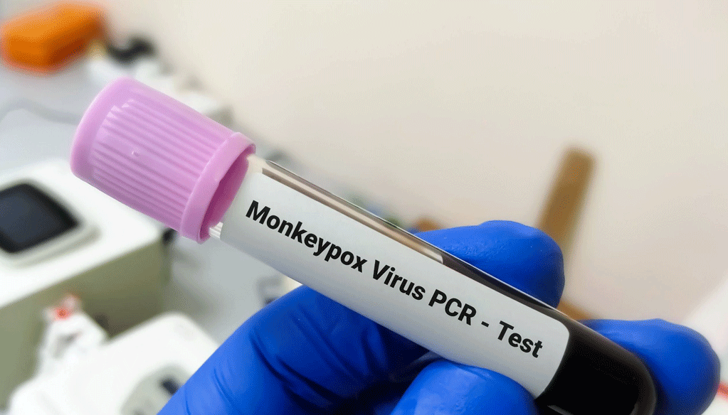 Monkeypox : 3 cas suspects au Maroc, aucun cas confirmé Monkeypox : 3 cas suspects au Maroc, aucun cas confirmé